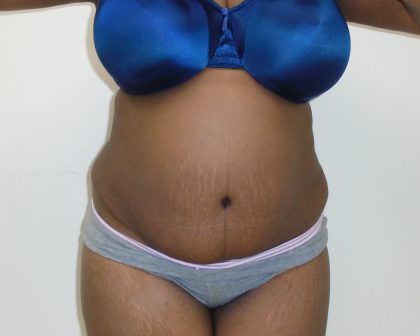 Lipo 360 Before & After Patient #532