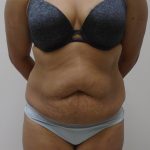 Lipo 360 Before & After Patient #523