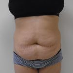 Lipo 360 Before & After Patient #511