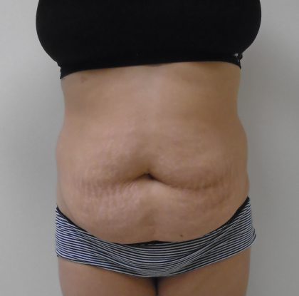 Lipo 360 Before & After Patient #511