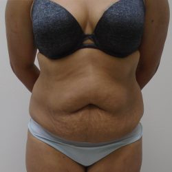 Lipo 360 Before & After Patient #523