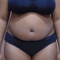Lipo 360 Before & After Patient #502