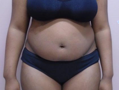 Lipo 360 Before & After Patient #502