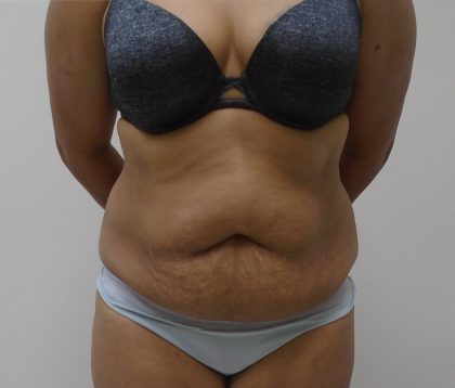 Lipo 360 Before & After Patient #523