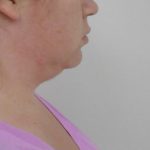 Chin Before & After Patient #479
