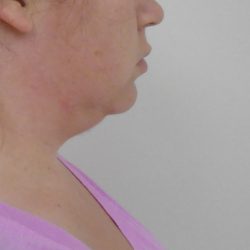 Chin Before & After Patient #479