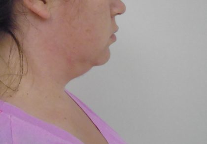 Chin Before & After Patient #479