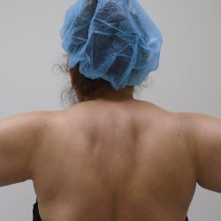 Arm Liposuction Before & After Patient #396