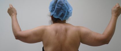 Arm Liposuction Before & After Patient #396