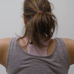 Arm Liposuction Before & After Patient #422
