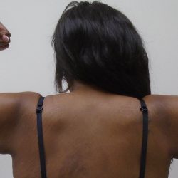 Arm Liposuction Before & After Patient #437