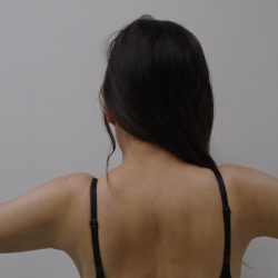 Arm Liposuction Before & After Patient #434