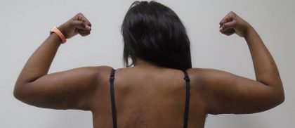 Arm Liposuction Before & After Patient #437