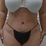 Lipo 360 Before & After Patient #568