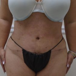 Lipo 360 Before & After Patient #568