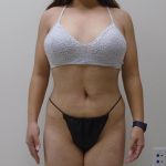 Lipo 360 Before & After Patient #556