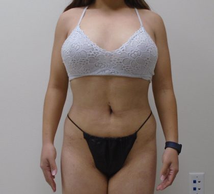 Lipo 360 Before & After Patient #556
