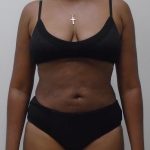 Lipo 360 Before & After Patient #529