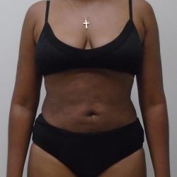 Lipo 360 Before & After Patient #529