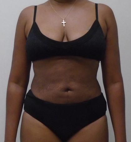 Lipo 360 Before & After Patient #529