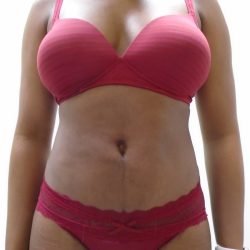 Lipo 360 Before & After Patient #520