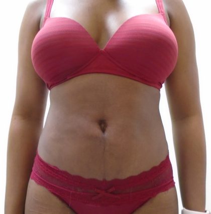 Lipo 360 Before & After Patient #520