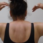 Arm Liposuction Before & After Patient #396