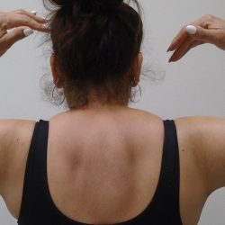 Arm Liposuction Before & After Patient #396