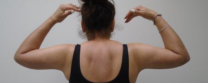 Arm Liposuction Before & After Patient #396