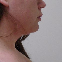Chin Before & After Patient #479