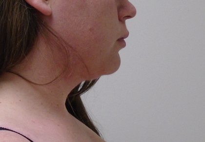 Chin Before & After Patient #479