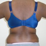 Lipo 360 Before & After Patient #532