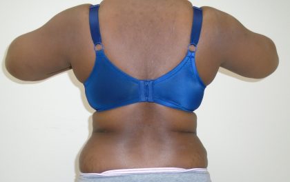 Lipo 360 Before & After Patient #532
