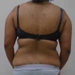 Lipo 360 Before & After Patient #523