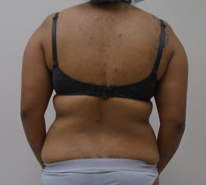 Lipo 360 Before & After Patient #523
