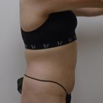 Lipo 360 Before & After Patient #556