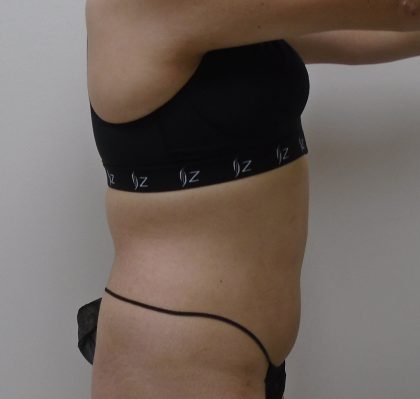 Lipo 360 Before & After Patient #556