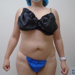 Lipo 360 Before & After Patient #541