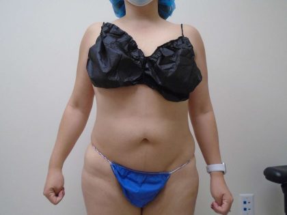 Lipo 360 Before & After Patient #541