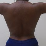 Lipo 360 Before & After Patient #532