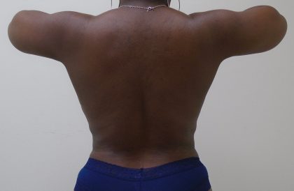Lipo 360 Before & After Patient #532