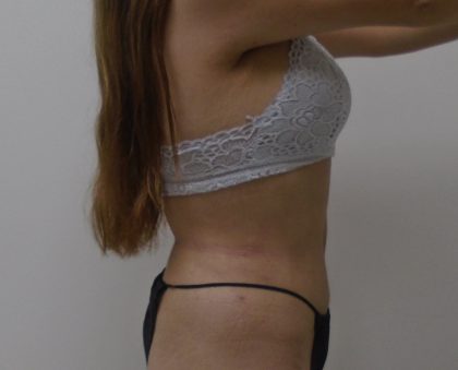 Lipo 360 Before & After Patient #556