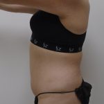 Lipo 360 Before & After Patient #556