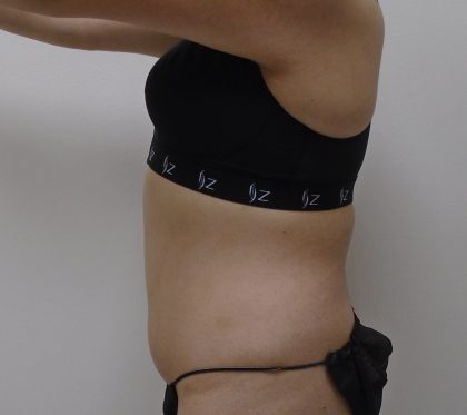 Lipo 360 Before & After Patient #556