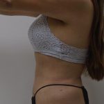 Lipo 360 Before & After Patient #556