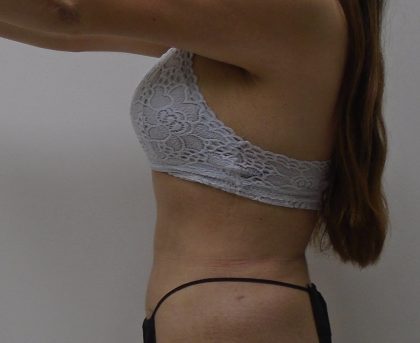 Lipo 360 Before & After Patient #556