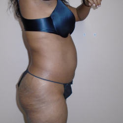 Lipo 360 Before & After Patient #492