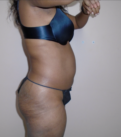 Lipo 360 Before & After Patient #492