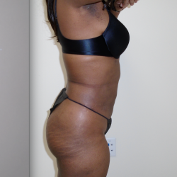 Lipo 360 Before & After Patient #492