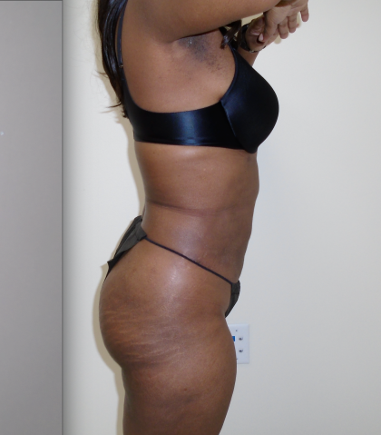 Lipo 360 Before & After Patient #492